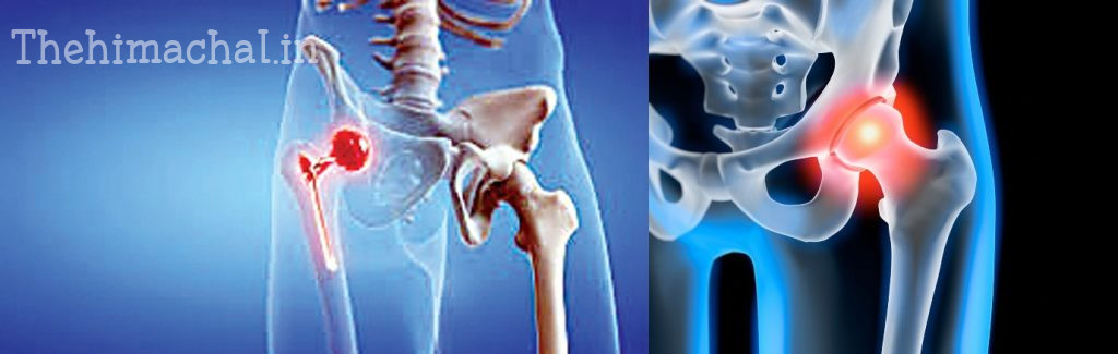 dharamshala-first-hip-replacement-surgery-success